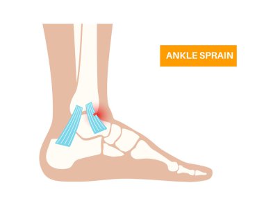 Bileğimi burktum. Çarpık ayaklar, acı ve şişlik. Göz yaşları, esneme ya da bağlarda yırtılma. Klinikte ayak travması anatomik poster, teşhis ve tedavi. Bacak problemi, X ışını vektör çizimi