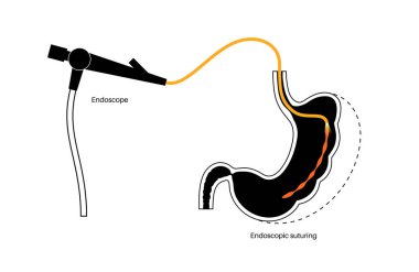 Endoskopik kollu gastroplasti. Mide ameliyatı, kilo kaybı mide ameliyatı. Laparoskopi konsepti. İnsan vücudunda aşırı kilo problemi. Ameliyattan sonra iç organ. Düz vektör tıbbi illüstrasyon