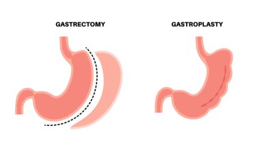 Endoskopik kollu gastroplasti ve gastrektomi ameliyatı. Mide ameliyatı, kilo kaybı mide ameliyatı. Laparoskopi konsepti. İnsan vücudu düz vektör medikal illüstrasyonunda aşırı kilolu problem