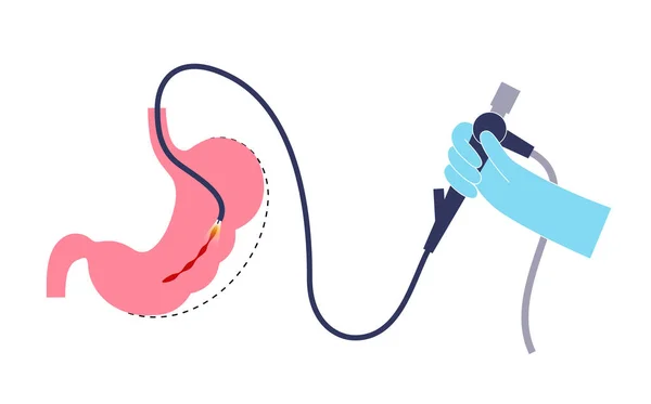 内視鏡スリーブ消化管 胃の手術 減量胃の手順 腹腔鏡の概念 人間の体の過体重の問題 手術後の内臓 フラットベクトル医療イラスト — ストックベクタ