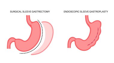 Endoskopik kollu gastroplasti ve gastrektomi ameliyatı. Mide ameliyatı, kilo kaybı mide ameliyatı. Laparoskopi konsepti. İnsan vücudu düz vektör medikal illüstrasyonunda aşırı kilolu problem