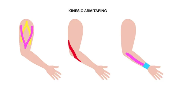 Elastic Therapeutic Tape Kinesiology Tape Arm Method Elastic Strip Purported — Stock Vector