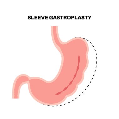 Endoskopik kollu gastroplasti. Mide ameliyatı, kilo kaybı mide ameliyatı. Laparoskopi konsepti. İnsan vücudunda aşırı kilo problemi. Ameliyattan sonra iç organ. Düz vektör tıbbi illüstrasyon