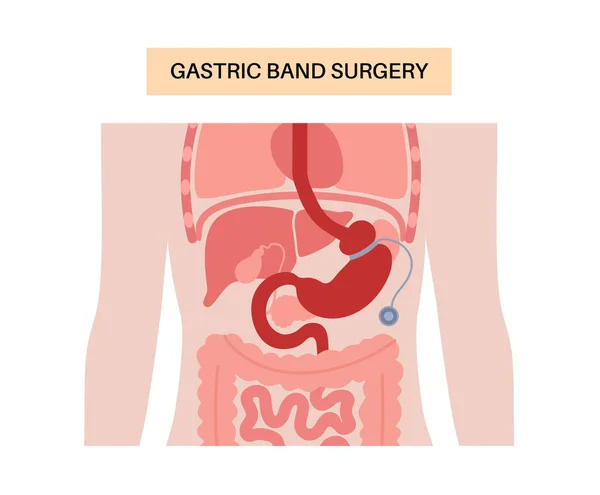 ガストリックバンドの医療処置 Gb胃手術のコンセプト 肥満問題 減量プロセス アブドゥーム腹腔鏡解剖学ポスター クリニック用の人体フラットベクターイラストの重量 — ストックベクタ