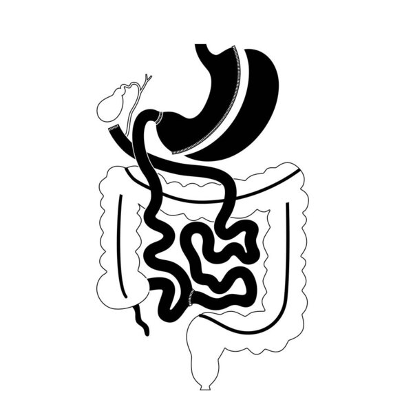 Biliopancreatic diversion with duodenal switch. BPD stomach surgery concept, weight loss gastric procedure. Abdomen laparoscopy. Overweight and obesity in human body flat vector medical illustration