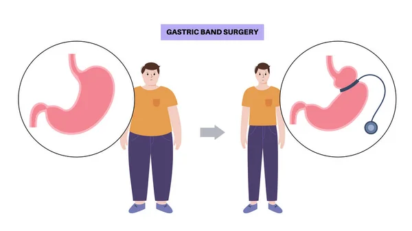 ガストリックバンドの医療処置 Gb胃手術のコンセプト 肥満問題 減量プロセス アブドゥーム腹腔鏡解剖学ポスター クリニック用の人体フラットベクターイラストの重量 — ストックベクタ