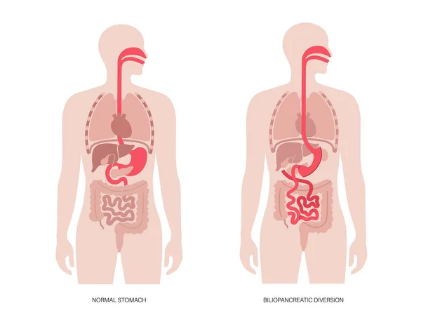 有十二指肠开关的胆囊炎转移 Bpd胃手术 减肥胃手术 手术前后的内脏器官 超重和肥胖问题平面病媒说明 — 图库矢量图片