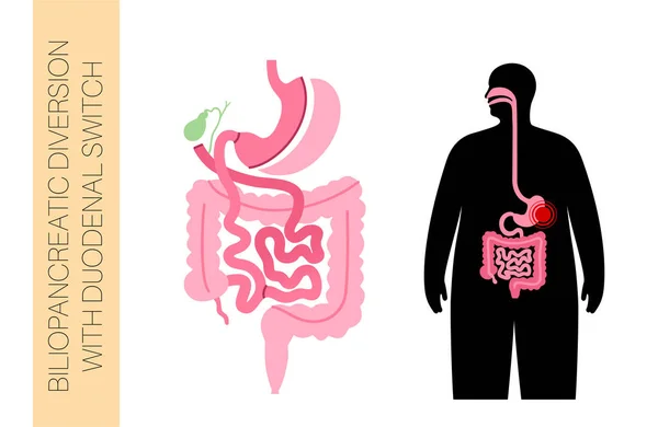 有十二指肠开关的胆囊炎转移 Bpd胃外科概念 体重减轻胃手术 Abdomen腹腔镜检查 人体扁平载体中的超重和肥胖医学说明 — 图库矢量图片