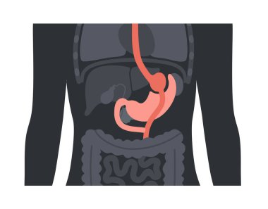 Gastrik baypas gastroplasti ameliyatı. RYGB mide ameliyatı konsepti, obezite sorunu, kilo verme prosedürü. Karın laparoskopisi tıbbi afişi. İnsan vücudu vektör illüstrasyonunda aşırı kilolu problem