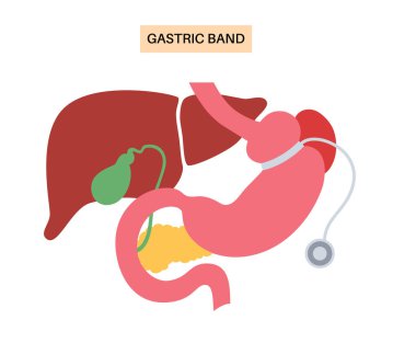 Gastrik bant tıbbi prosedürü. AGB mide ameliyatı konsepti, obezite sorunu, kilo verme süreci. Karın laparoskopisi anatomik poster. Klinik için insan vücudunda aşırı kilolu düz vektör çizimi