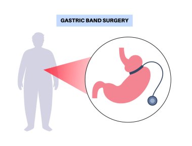 Gastrik bant tıbbi prosedürü. AGB mide ameliyatı konsepti, obezite sorunu, kilo verme süreci. Karın laparoskopisi anatomik poster. Klinik için insan vücudunda aşırı kilolu düz vektör çizimi