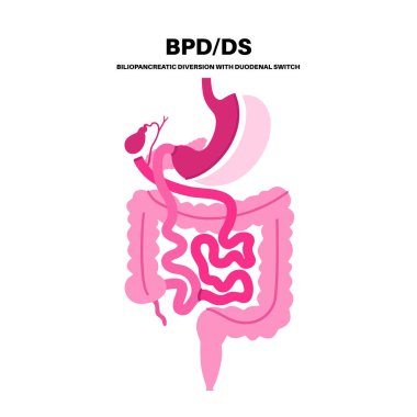 Duodenal anahtarla biliopancreatic saptırma. BPD mide ameliyatı konsepti, kilo kaybı mide ameliyatı. Karın laparoskopisi. İnsan vücudunda aşırı kilolu ve obezite düz vektör tıbbi illüstrasyonunda