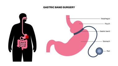 Gastrik bant tıbbi prosedürü. AGB mide ameliyatı konsepti, obezite sorunu, kilo verme süreci. Karın laparoskopisi anatomik poster. Klinik için insan vücudunda aşırı kilolu düz vektör çizimi
