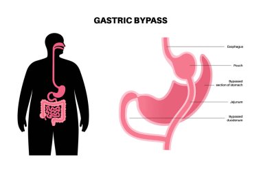 Gastrik baypas gastroplasti ameliyatı. RYGB mide ameliyatı konsepti, obezite sorunu, kilo verme prosedürü. Karın laparoskopisi tıbbi afişi. Erkek vücut vektörü illüstrasyonunda aşırı kilolu problem