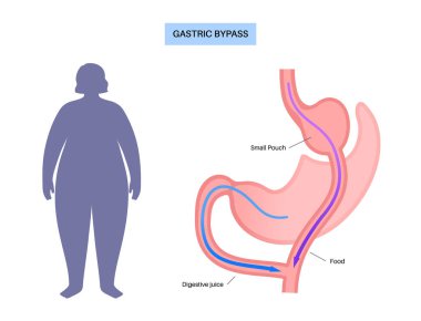 Gastrik baypas gastroplasti ameliyatı. RYGB mide ameliyatı konsepti, obezite sorunu, kilo verme prosedürü. Karın laparoskopisi tıbbi afişi. Kadın vücut vektörü illüstrasyonunda aşırı kilolu problem