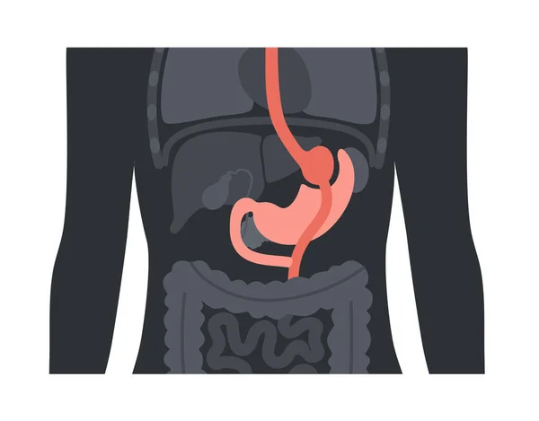 Operace Žaludečního Bypassu Rygb Žaludeční Chirurgie Koncept Obezita Problém Hubnutí — Stockový vektor