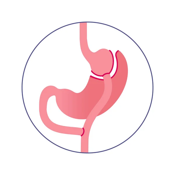 Operazione Gastrica Bypass Gastroplastico Rygb Concetto Chirurgia Dello Stomaco Problema — Vettoriale Stock