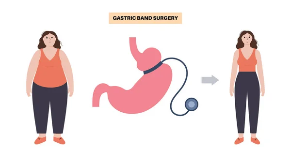 Procedimiento Médico Banda Gástrica Concepto Cirugía Estómago Agb Problema Obesidad — Archivo Imágenes Vectoriales
