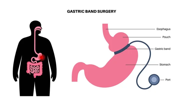 Procedimento Médico Banda Gástrica Agb Conceito Cirurgia Estômago Problema Obesidade — Vetor de Stock
