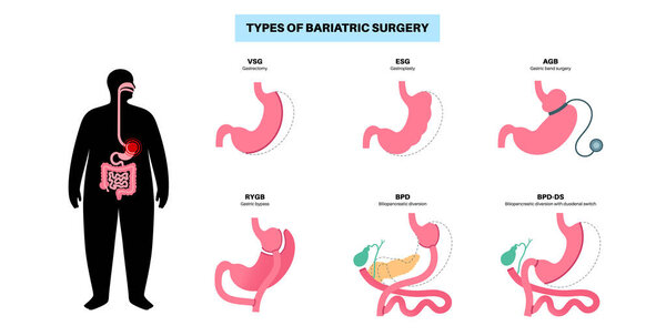 Types of bariatric surgery. Healthy stomach and internal organs after operation, weight loss gastric procedure. Abdomen laparoscopy concept. Overweight and obesity problem flat vector illustration