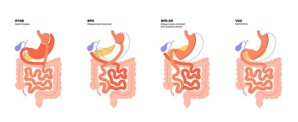 Types of bariatric surgery. Healthy stomach and internal organs after operation, weight loss gastric procedure. Abdomen laparoscopy concept. Overweight and obesity problem flat vector illustration