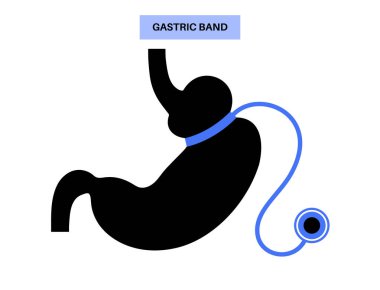 Gastrik bant tıbbi prosedürü. AGB mide ameliyatı konsepti, obezite sorunu, kilo verme süreci. Karın laparoskopisi anatomik poster. Klinik için insan vücudunda aşırı kilolu düz vektör çizimi