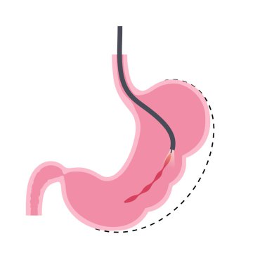 Endoskopik kollu gastroplasti. Mide ameliyatı, kilo kaybı mide ameliyatı. Laparoskopi konsepti. İnsan vücudunda aşırı kilo problemi. Ameliyattan sonra iç organ. Düz vektör tıbbi illüstrasyon