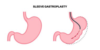 Endoskopik kollu gastroplasti. Mide ameliyatı, kilo kaybı mide ameliyatı. Laparoskopi konsepti. Ameliyattan önce ve sonra insan vücudunda aşırı kilo problemi. Düz vektör tıbbi illüstrasyon