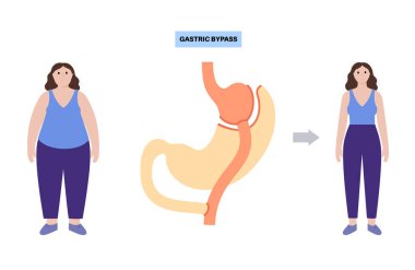 Gastrik baypas gastroplasti ameliyatı. Karın ameliyatından önce ve sonra kadın vücudu. Obezite sorunu, kilo verme prosedürü. Karın laparoskopisi tıbbi afişi. Aşırı kilolu problem vektör illüstrasyonu