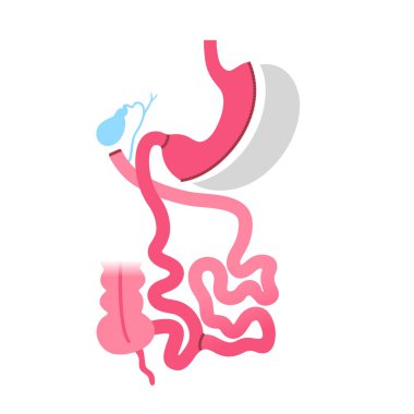Duodenal anahtarla biliopancreatic saptırma. BPD mide ameliyatı konsepti, kilo kaybı mide ameliyatı. Karın laparoskopisi. İnsan vücudunda aşırı kilolu ve obezite düz vektör tıbbi illüstrasyonunda