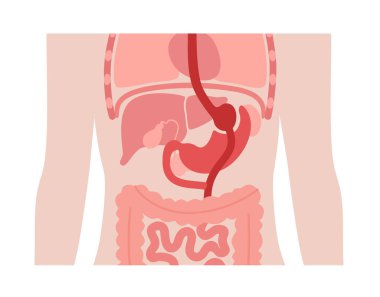 Gastrik baypas gastroplasti ameliyatı. RYGB mide ameliyatı konsepti, obezite sorunu, kilo verme prosedürü. Karın laparoskopisi tıbbi afişi. İnsan vücudu vektör illüstrasyonunda aşırı kilolu problem