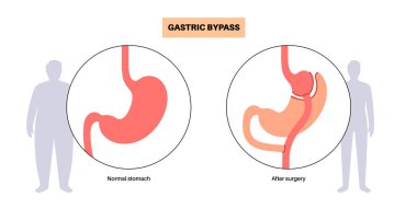 Gastrik baypas gastroplasti ameliyatı. Mide ameliyatından önce ve sonra erkek cesedi. Obezite sorunu, kilo verme prosedürü. Karın laparoskopisi tıbbi afişi. Aşırı kilolu problem vektör illüstrasyonu