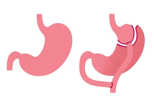 胃潰瘍の胃の動作を胃パスする 手術前および手術後の人体器官 肥満の問題 減量手順 アブドゥム腹腔鏡検査 医療ポスター 重量問題ベクトルイラスト — ストックベクタ