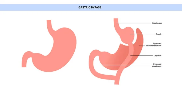 Contournement Gastrique Gastroplastie Opération Estomac Organes Humains Avant Après Opération — Image vectorielle