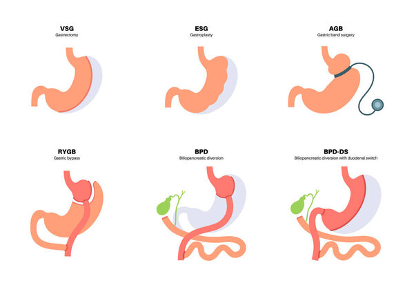 Types of bariatric surgery. Healthy stomach and internal organs after operation, weight loss gastric procedure. Abdomen laparoscopy concept. Overweight and obesity problem flat vector illustration