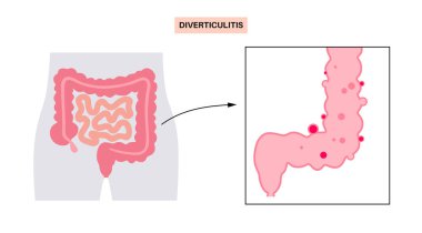 Divertikülit ve divertiküloz hastalıkları. Bağırsak duvarlarında divertiküla var. Kalın bağırsak ağrısı. İnsan bağırsağında iltihap ya da enfeksiyon. Sindirim sistemi düz vektör illüstrasyonunda şişkin keseler