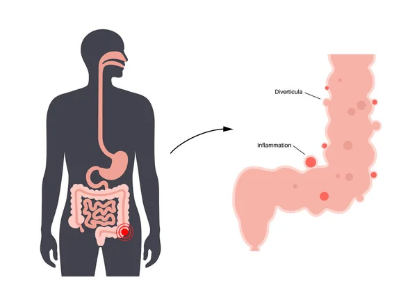 肝炎および分裂症の病気 腸の壁のディスティックラ 植民地での痛み 人間の腸の炎症または感染 消化器系フラットベクターイラストの膨らみポーチ — ストックベクタ