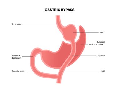 Gastrik baypas gastroplasti ameliyatı. RYGB mide ameliyatı konsepti, obezite sorunu, kilo verme prosedürü. Karın laparoskopisi tıbbi afişi. İnsan vücudu vektör illüstrasyonunda aşırı kilolu problem