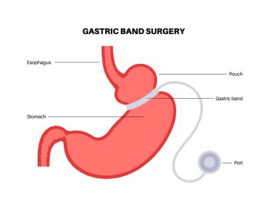 Gastrik bant tıbbi prosedürü. AGB mide ameliyatı konsepti, obezite sorunu, kilo verme süreci. Karın laparoskopisi anatomik poster. Klinik için insan vücudunda aşırı kilolu düz vektör çizimi
