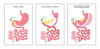 Biliopancreatic diversion with duodenal switch. BPD stomach surgery, weight loss gastric procedure. Internal organs before and after operation. Overweight and obesity problem flat vector illustration clipart