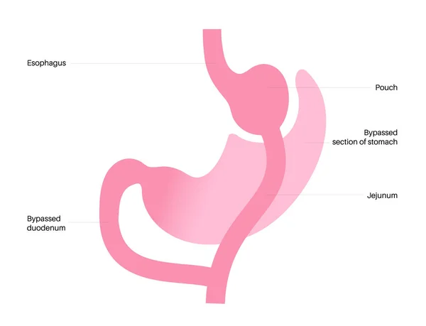 Cirugía Gastroplastia Bypass Gástrico Rygb Concepto Cirugía Estómago Problema Obesidad — Vector de stock