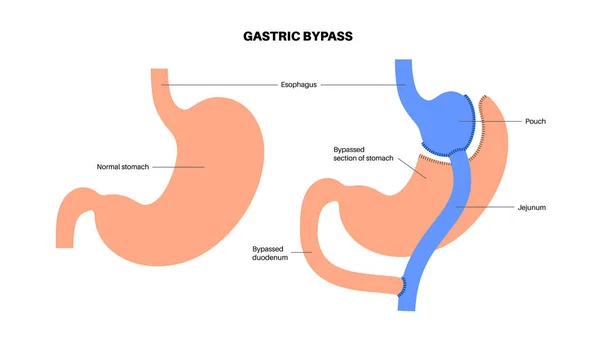 Bypass Gástrico Gastroplastia Operación Estomacal Órganos Humanos Antes Después Cirugía — Archivo Imágenes Vectoriales