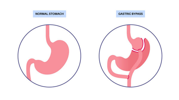 Gastric bypass gastroplasty stomach operation. Human organs before and after surgery. Obesity problem, weight loss procedure. Abdomen laparoscopy medical poster. Overweight problem vector illustration