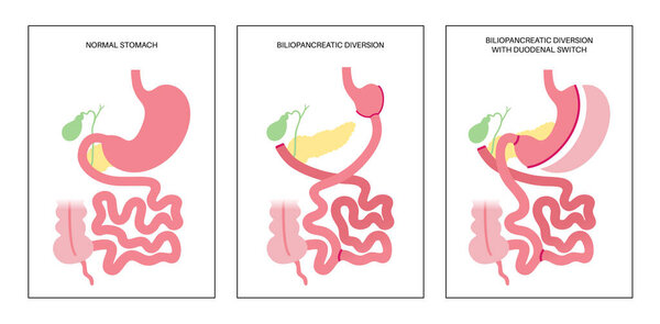 Biliopancreatic diversion with duodenal switch. BPD stomach surgery, weight loss gastric procedure. Internal organs before and after operation. Overweight and obesity problem flat vector illustration