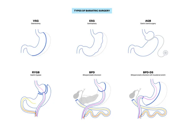 stock vector Types of bariatric surgery. Healthy stomach and internal organs after operation, weight loss gastric procedure. Abdomen laparoscopy concept. Overweight and obesity problem flat vector illustration