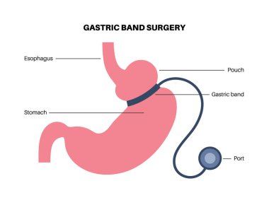 Gastrik bant tıbbi prosedürü. AGB mide ameliyatı konsepti, obezite sorunu, kilo verme süreci. Karın laparoskopisi anatomik poster. Klinik için insan vücudunda aşırı kilolu düz vektör çizimi
