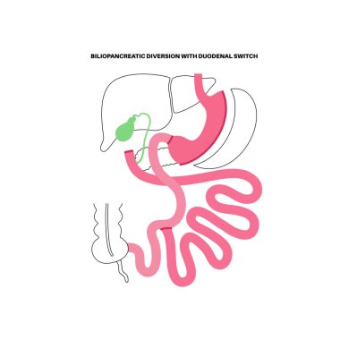 Duodenal anahtarla biliopancreatic saptırma. BPD mide ameliyatı konsepti, kilo kaybı mide ameliyatı. Karın laparoskopisi. İnsan vücudunda aşırı kilolu ve obezite düz vektör tıbbi illüstrasyonunda