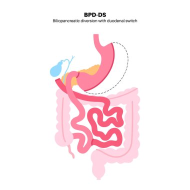 Duodenal anahtarla biliopancreatic saptırma. BPD mide ameliyatı konsepti, kilo kaybı mide ameliyatı. Karın laparoskopisi. İnsan vücudunda aşırı kilolu ve obezite düz vektör tıbbi illüstrasyonunda