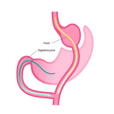 Gastrik baypas gastroplasti ameliyatı. RYGB mide ameliyatı konsepti, obezite sorunu, kilo verme prosedürü. Karın laparoskopisi tıbbi afişi. İnsan vücudu vektör illüstrasyonunda aşırı kilolu problem