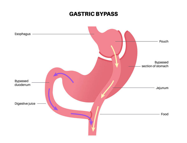 Gastric bypass gastroplasty operation. RYGB stomach surgery concept, obesity problem, weight loss procedure. Abdomen laparoscopy medical poster. Overweight problem in human body vector illustration